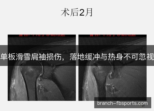 单板滑雪肩袖损伤，落地缓冲与热身不可忽视